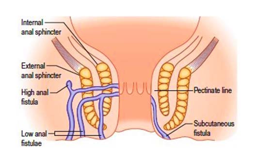 best of Repair anal fistula of Surgical