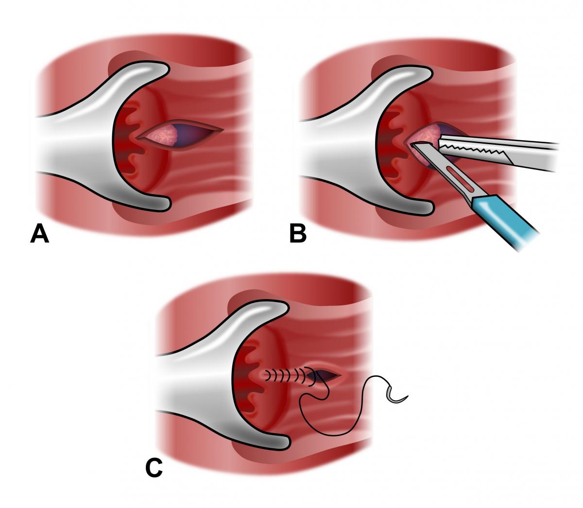 Surgical repair of anal fistula