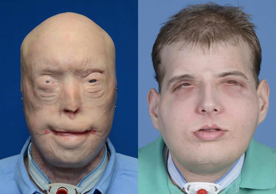 best of First transplant Facial picture