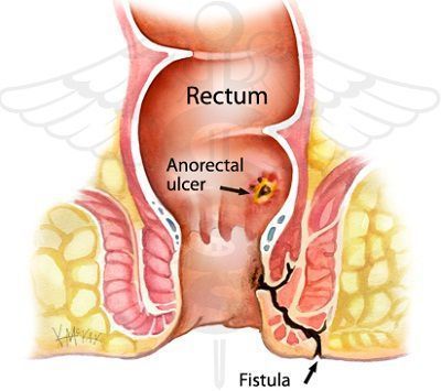 Surgical repair of anal fistula