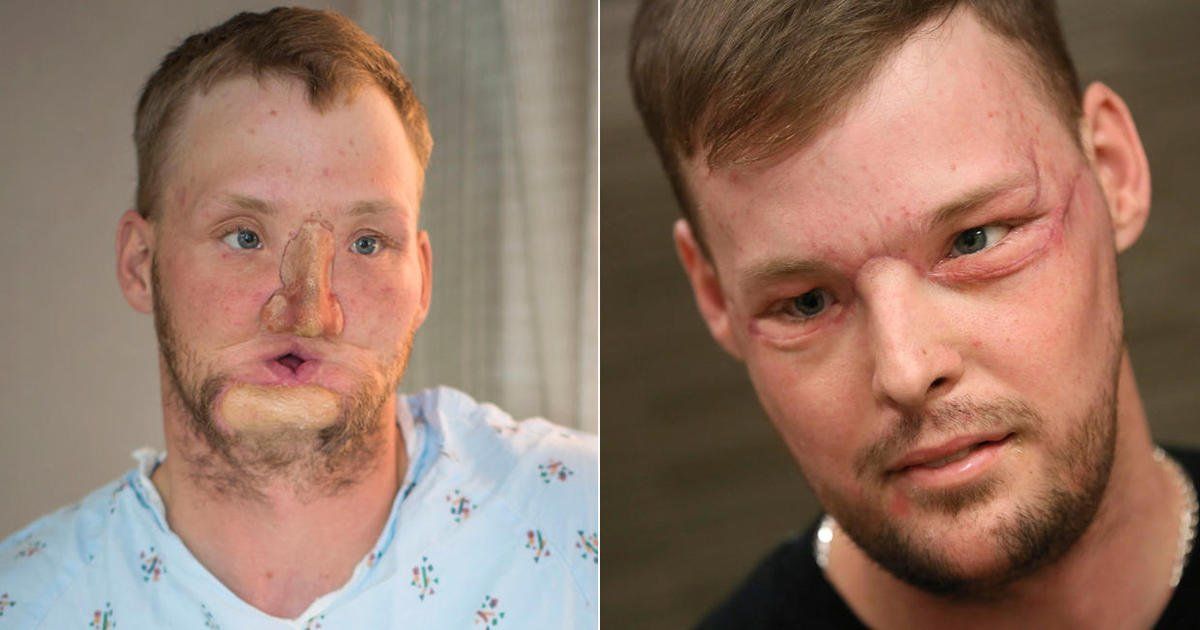 Dead R. reccomend Facial first picture transplant