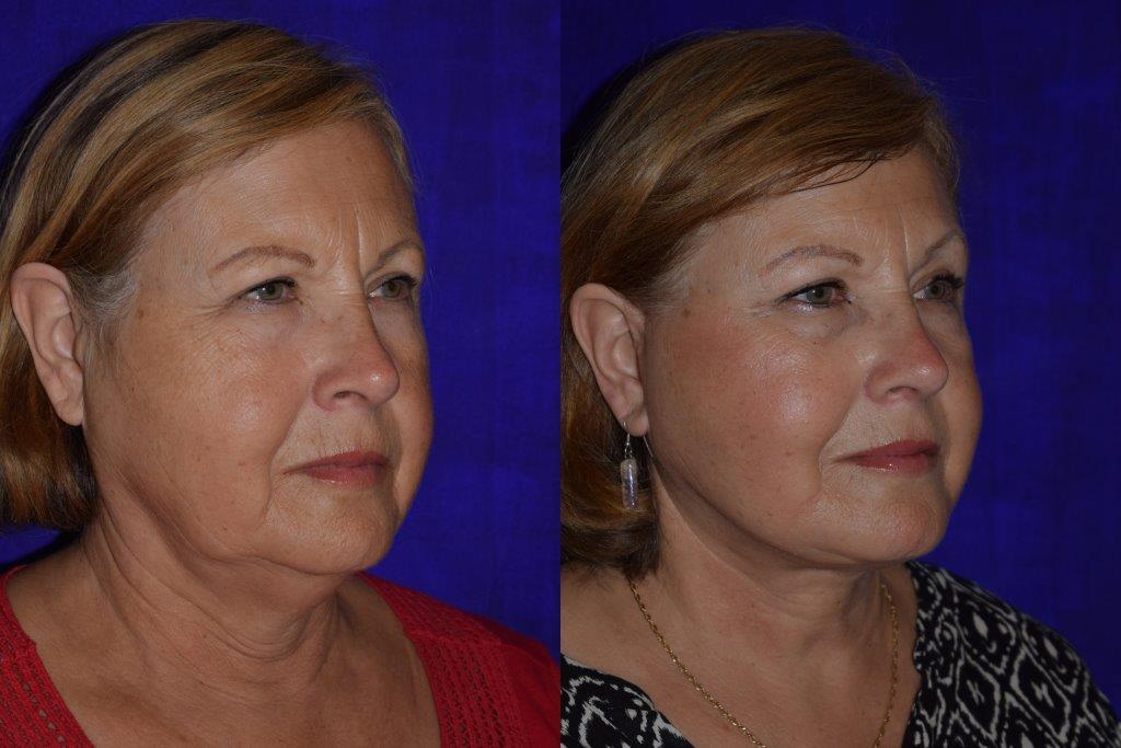 Brandy reccomend Facial plastic sonoma surgery