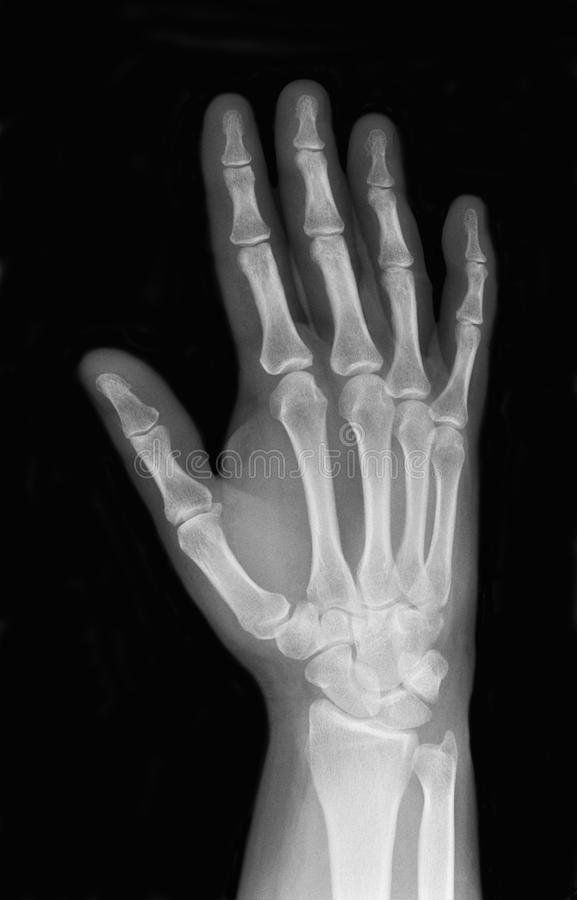 Right hand thumb bones