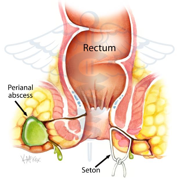 Surgical repair of anal fistula