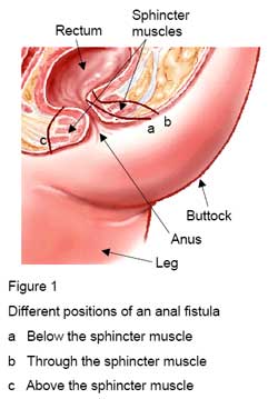 best of Repair anal fistula of Surgical