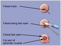 Fullback reccomend Surgical repair of anal fistula